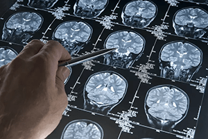 An Algorithm Can Predict When Alzheimer’s Symptoms Will Appear
